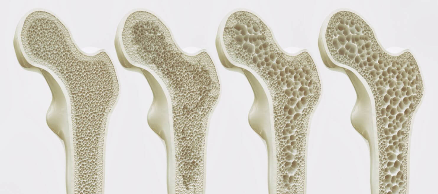 Az osteoporosis gyógyszeres kezelése